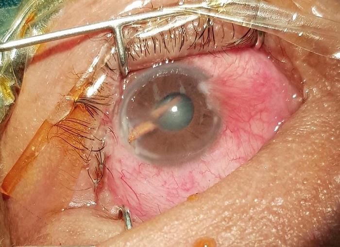 Đi làm rừng, người đàn ông Tuyên Hóa bị gai đâm thủng mắt
