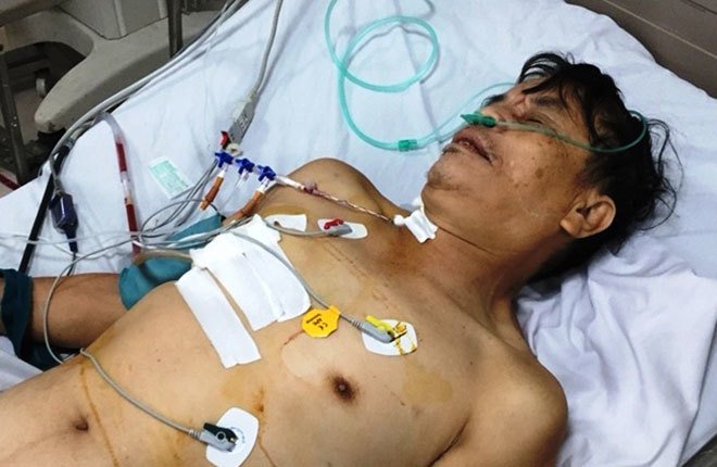 Nạn nhân bị vỡ tim sau tai nạn giao thông được cứu sống kỳ diệu Nạn nhân bị vỡ tim sau tai nạn giao thông được cứu sống kỳ diệu