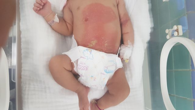 Quảng Bình:  Bé 14 ngày tuổi bỏng nặng vì đắp lá trầu không chữa chướng bụng